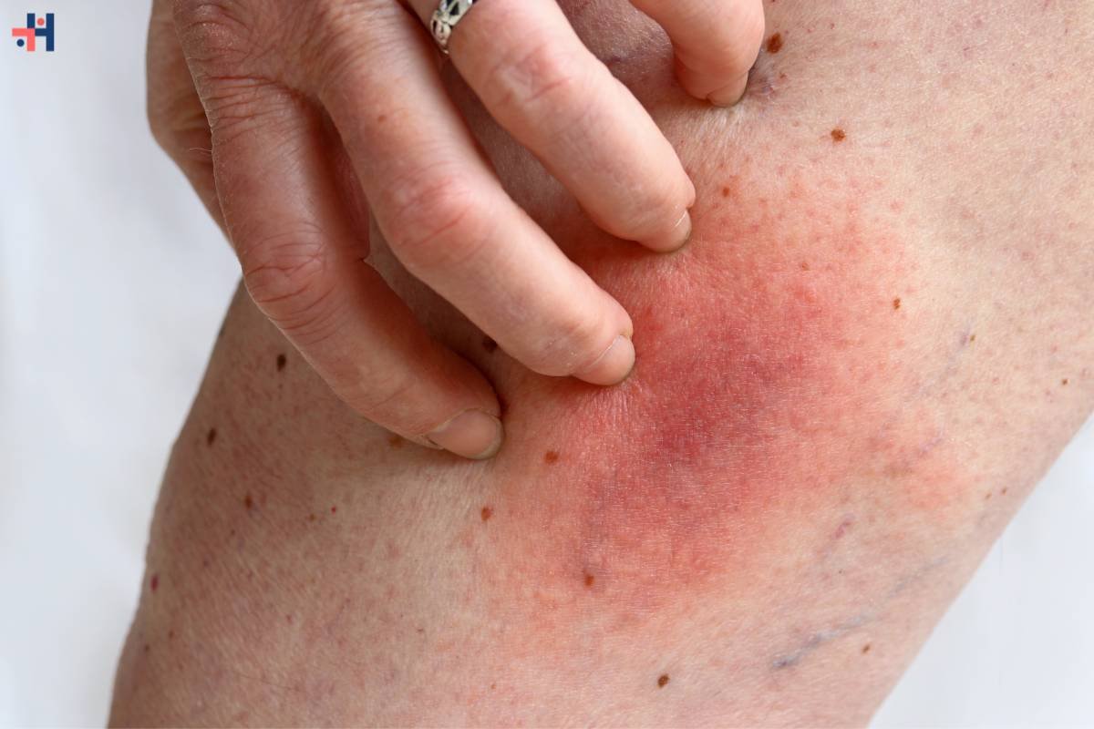 Bad Bug Bite? Learn When to Seek Urgent Medical Care for Relief | Healthcare 360 Magazine