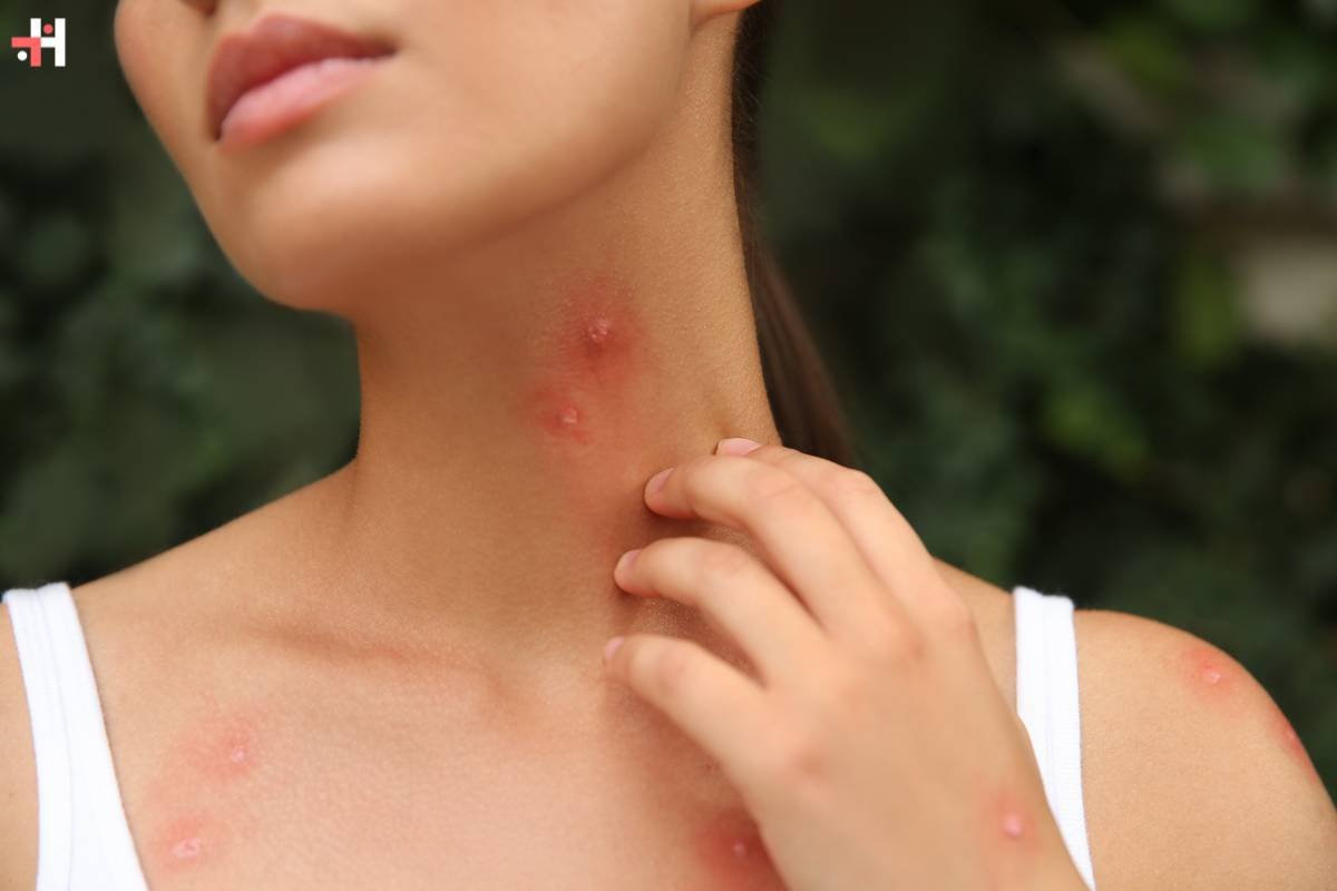 Bad Bug Bite? Knowing When to Seek Medical Attention