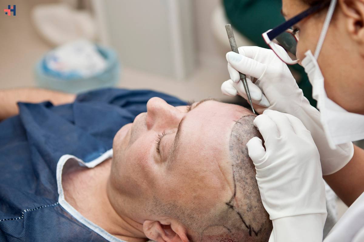 The Ultimate Guide to Hair Transplant: Everything You Need to Know | Healthcare 360 Magazine