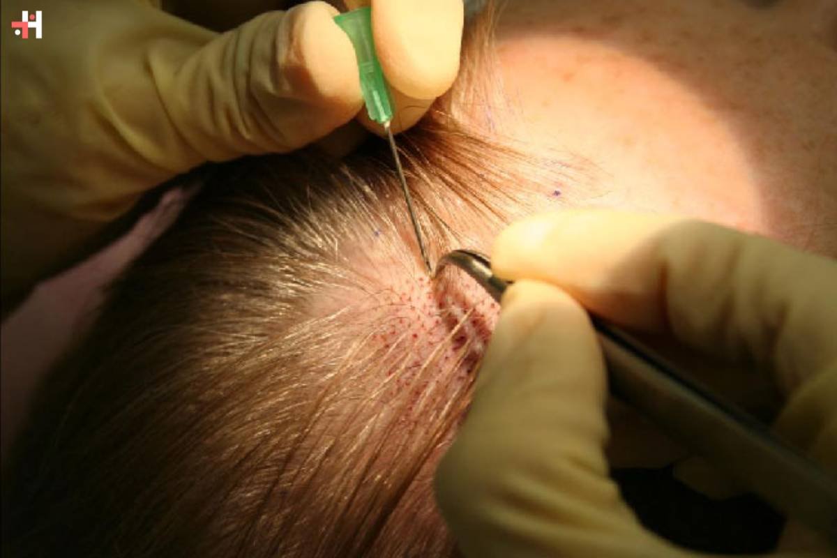 The Ultimate Guide to Hair Transplant: Everything You Need to Know | Healthcare 360 Magazine