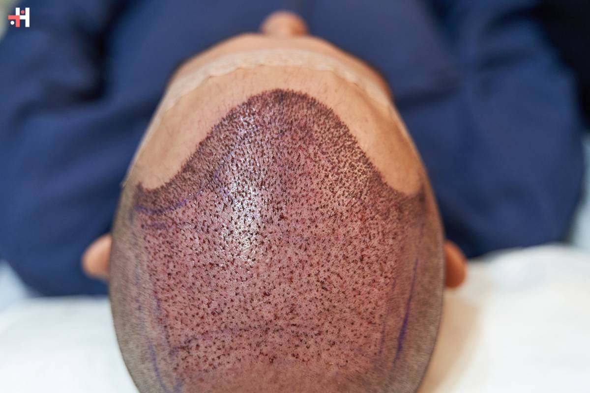 The Ultimate Guide to Hair Transplant: Everything You Need to Know | Healthcare 360 Magazine