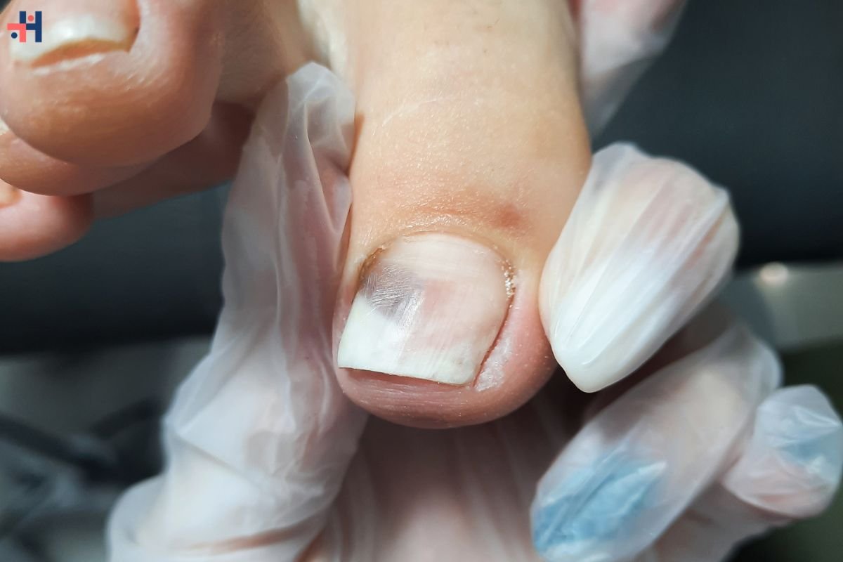The Causes and Treatment Options for Black Streaks in Toenails | Healthcare 360 Magazine