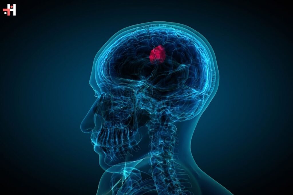 Glioblastoma: Innovative Therapy Shows Promise in Treating Deadly Brain Tumors | Healthcare 360 Magazine