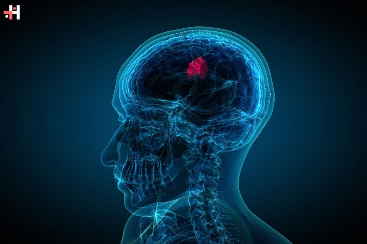 Glioblastoma: Innovative Therapy Shows Promise in Treating Deadly Brain Tumors | Healthcare 360 Magazine