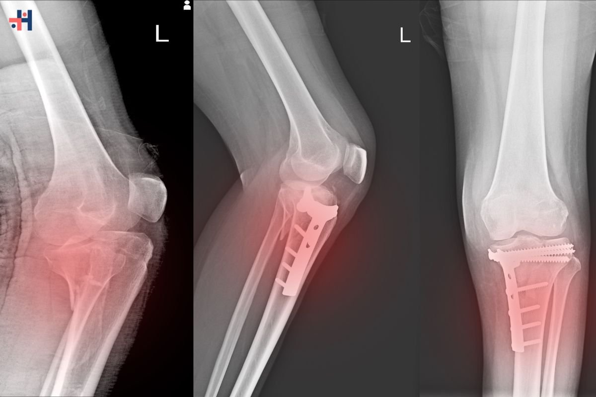 Understanding Bone Density: Key Factors, Measurement | Healthcare 360 Magazine