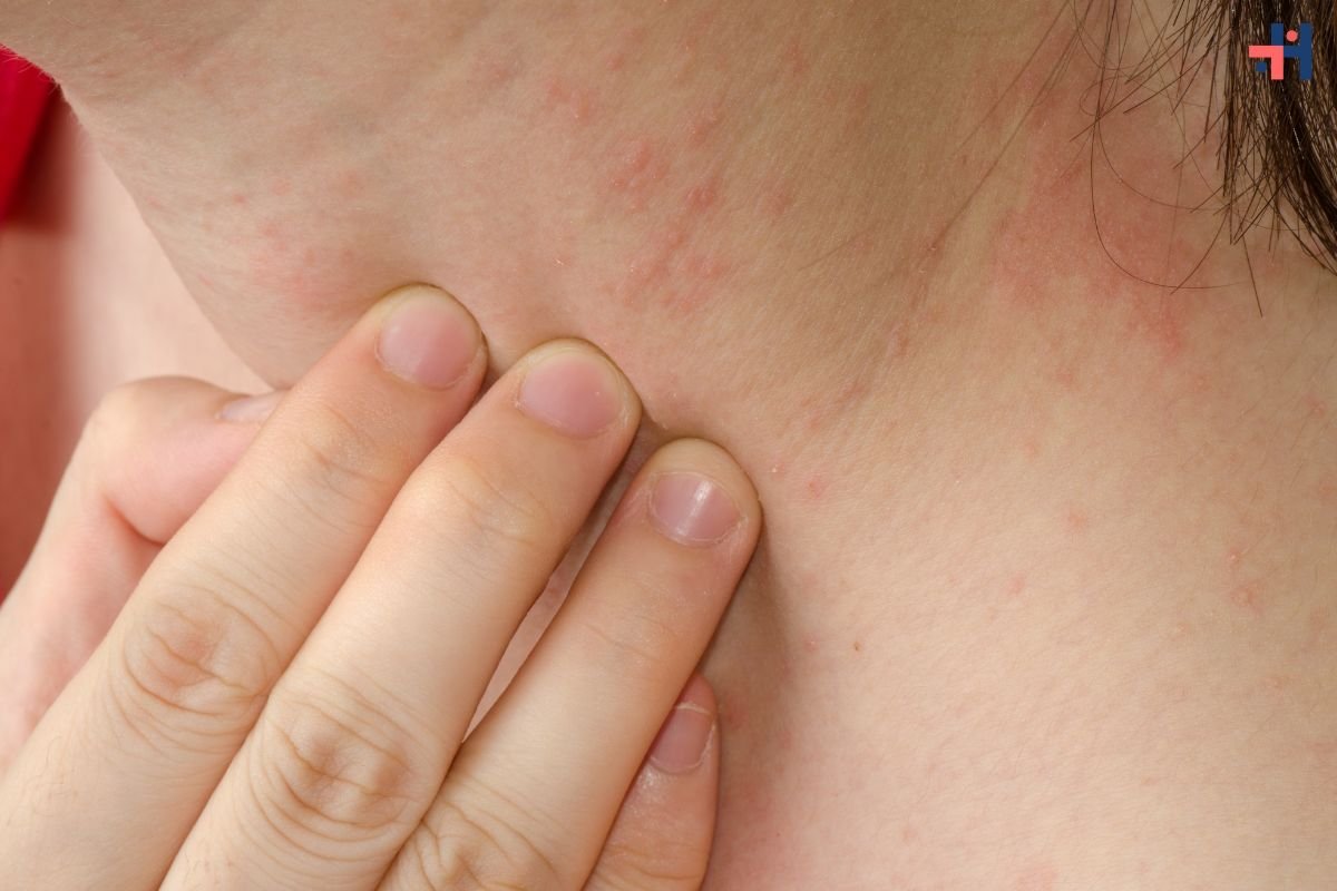 Everything You Need to Know about Dermatitis Eczema: Causes, Symptoms, and Treatments