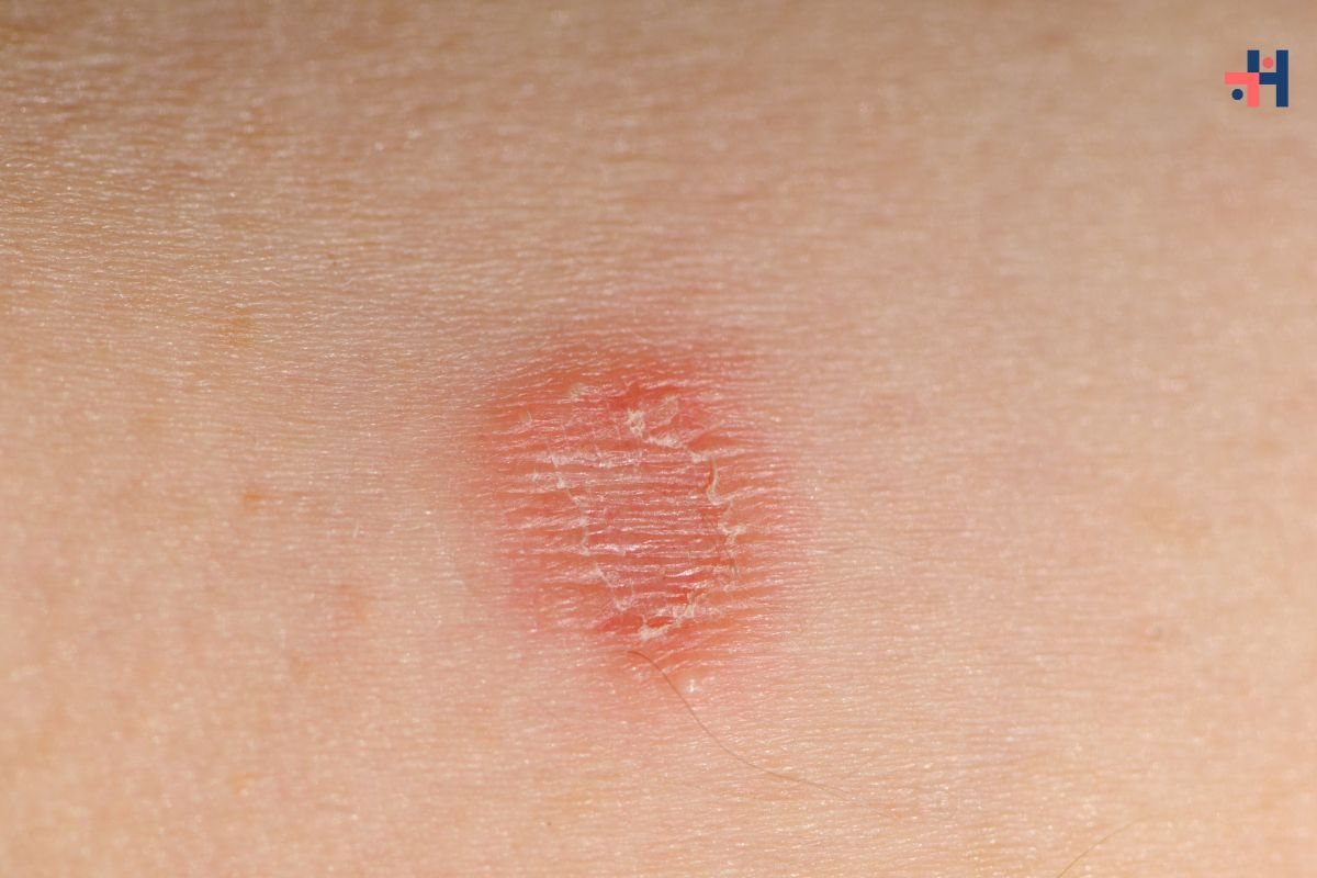 Understanding Ringworm Disease: Causes, Symptoms, and Treatments