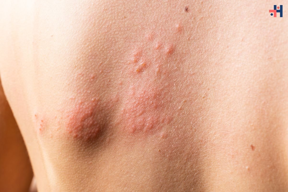 Dermatitis Eczema: Causes, Symptoms, and Treatments | Healthcare 360 Magazine