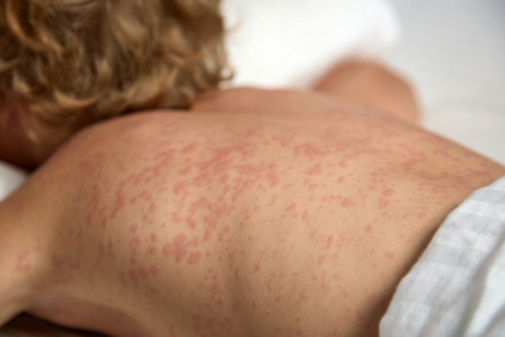 Measles Outbreak: 81 Cases and 13 Clusters Confirmed in Ireland This Year