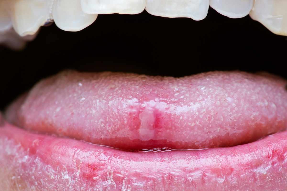 Canker Sore in Tongue: Causes, Symptoms, Treatment, and Prevention | Healthcare 360 Magazine