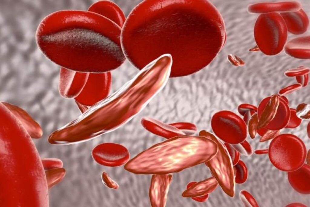 New Study Links Sickle Cell Disease Health Disparities to Community Factors