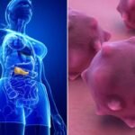 Pancreatic Cancer Surge Among Young People May Be Overstated