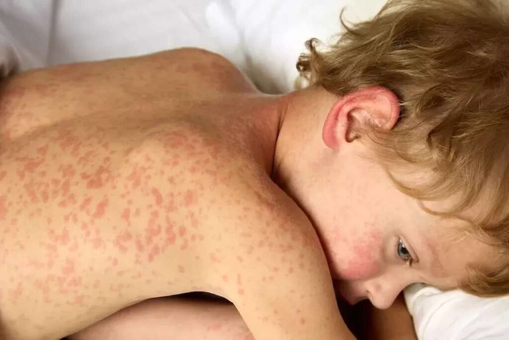 Texas Faces Worst Measles Outbreak in Decades,Cases Reach 48 | Healthcare 360 Magazine