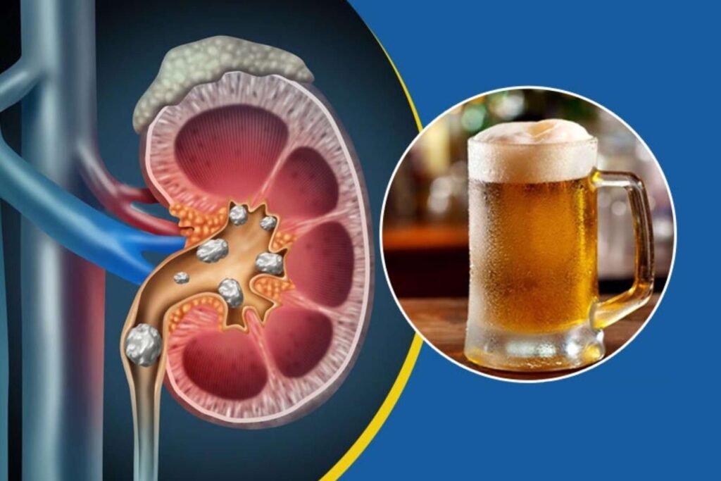 How Beer is Good for Kidney Stone Treatment Naturally? | Healthcare 360 Magazine