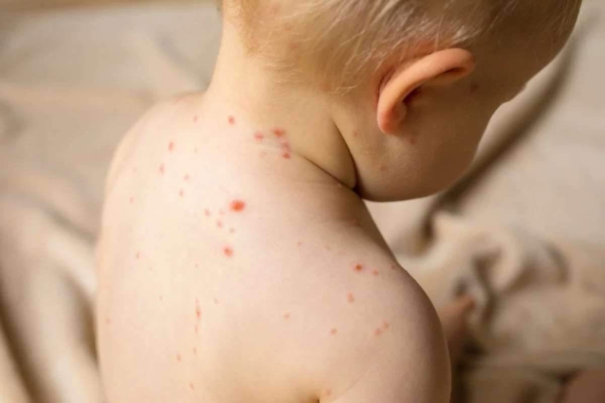 Measles Crisis: Texas Reports 90 Cases Across Multiple Counties | Healthcare 360 Magazine