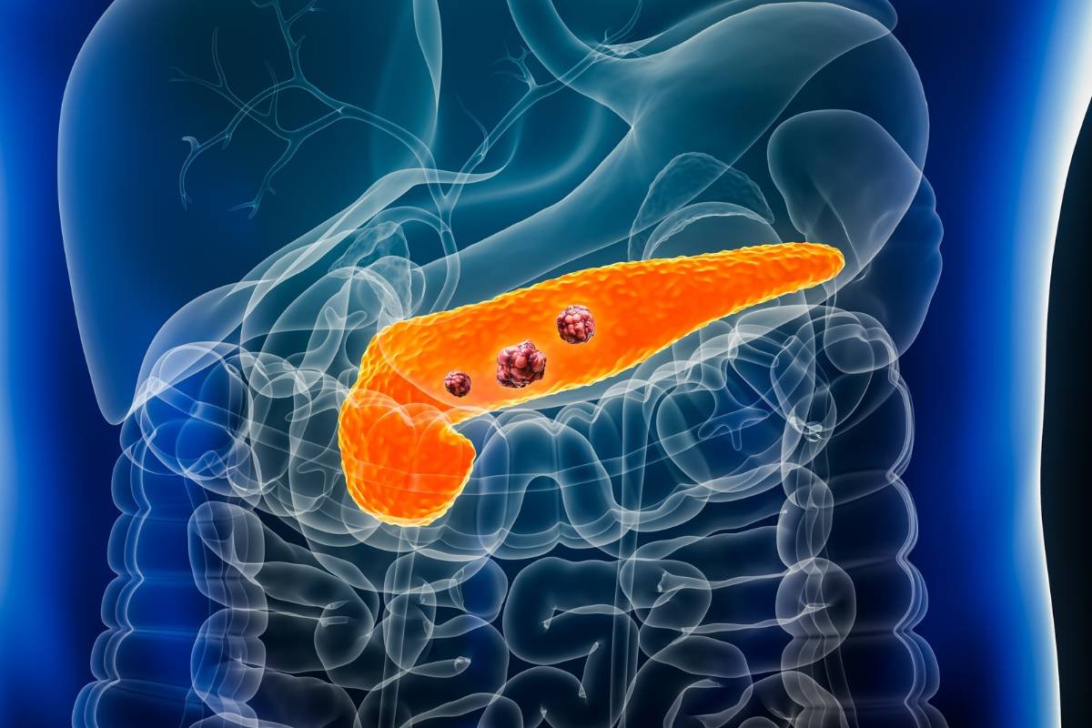 Breakthrough mRNA Vaccine Shows Promise in Pancreatic Cancer Treatment