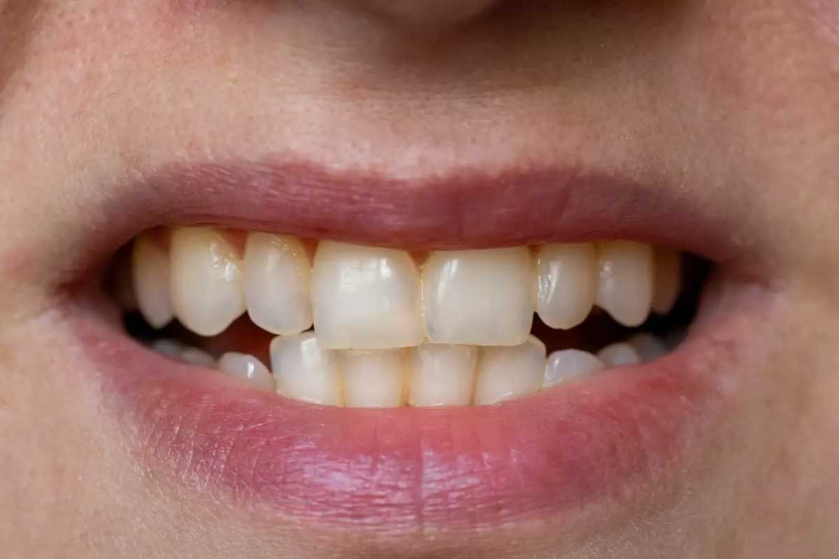 “Ozempic Teeth”: Dental Complications Add to Growing List of Weight-Loss Drug Concerns