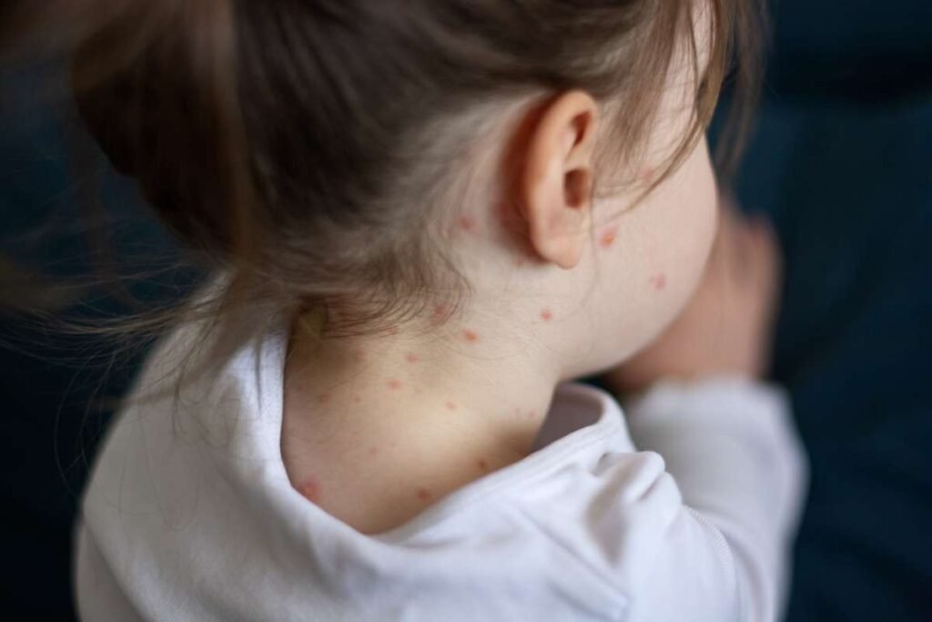 Anchorage Reports Measles Case in Unvaccinated Minor, Raising Community Exposure Concerns