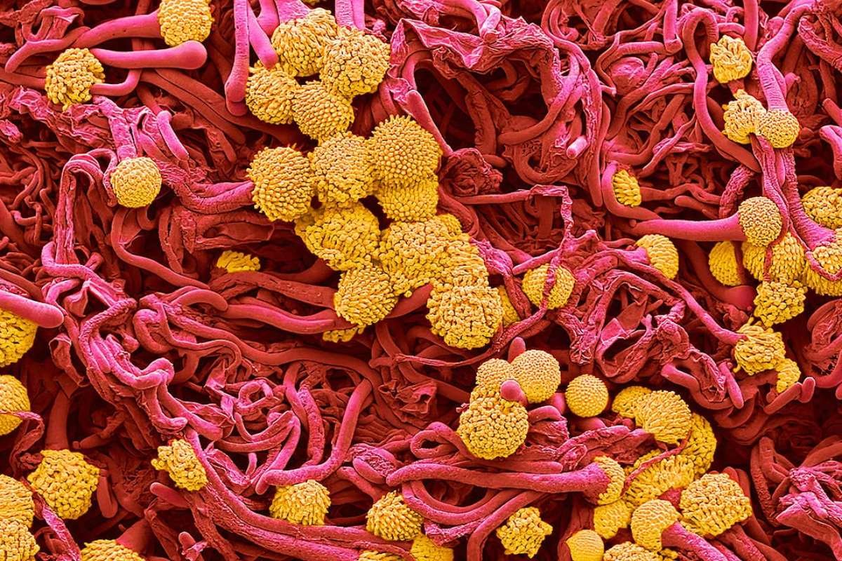 Lethal Fungus Threatens US Public Health as Climate and Drug Resistance Fuel Spread