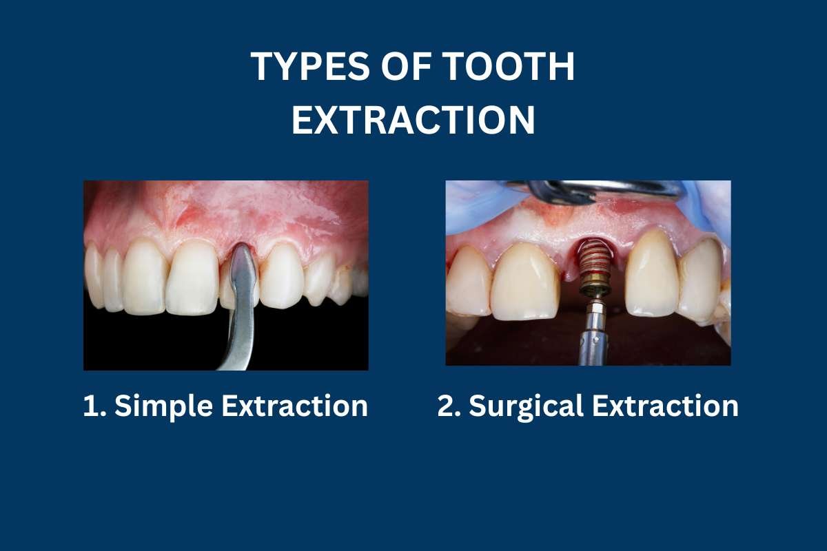 Tooth Extraction: Everything You Need To Know | Healthcare 360 Magazine