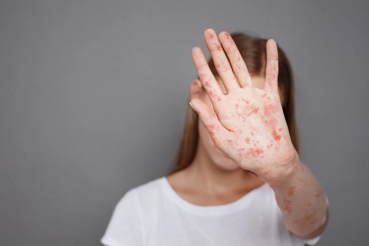 First Measles Case in 30 Years Reported in North Idaho