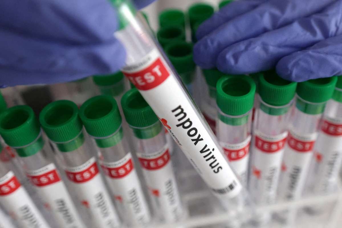 California reports first US mpox case of severe strain without travel history