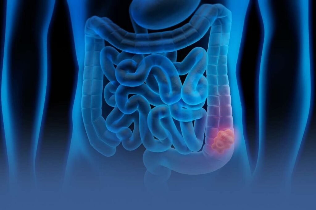 Colorectal Cancer Becomes Deadliest Cancer for Americans Under 50, New Data Shows