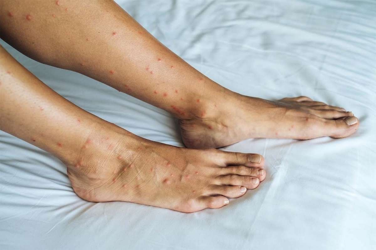 Flea Bite vs. Bed Bug Bite: Key Differences & Relief | Healthcare 360 Magazine
