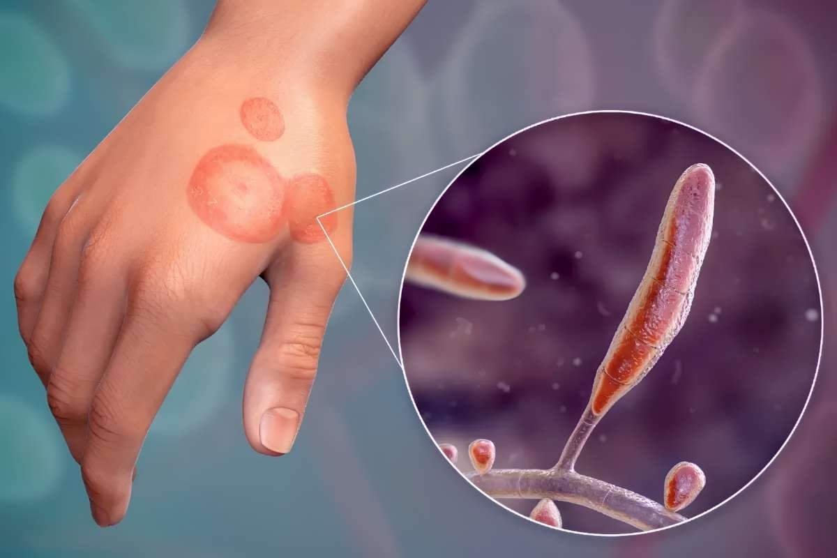 Drug-Resistant Ringworm Identified in 29 Countries as Cases Triple | Healthcare 360 Magazine