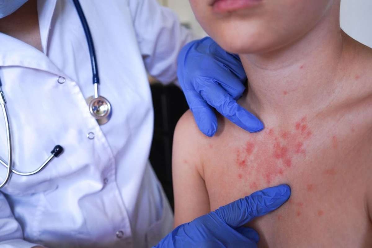 Pennsylvania Measles Outbreak Spurs Vaccinations Amid Community And Political Tensions | Healthcare 360 Magazine