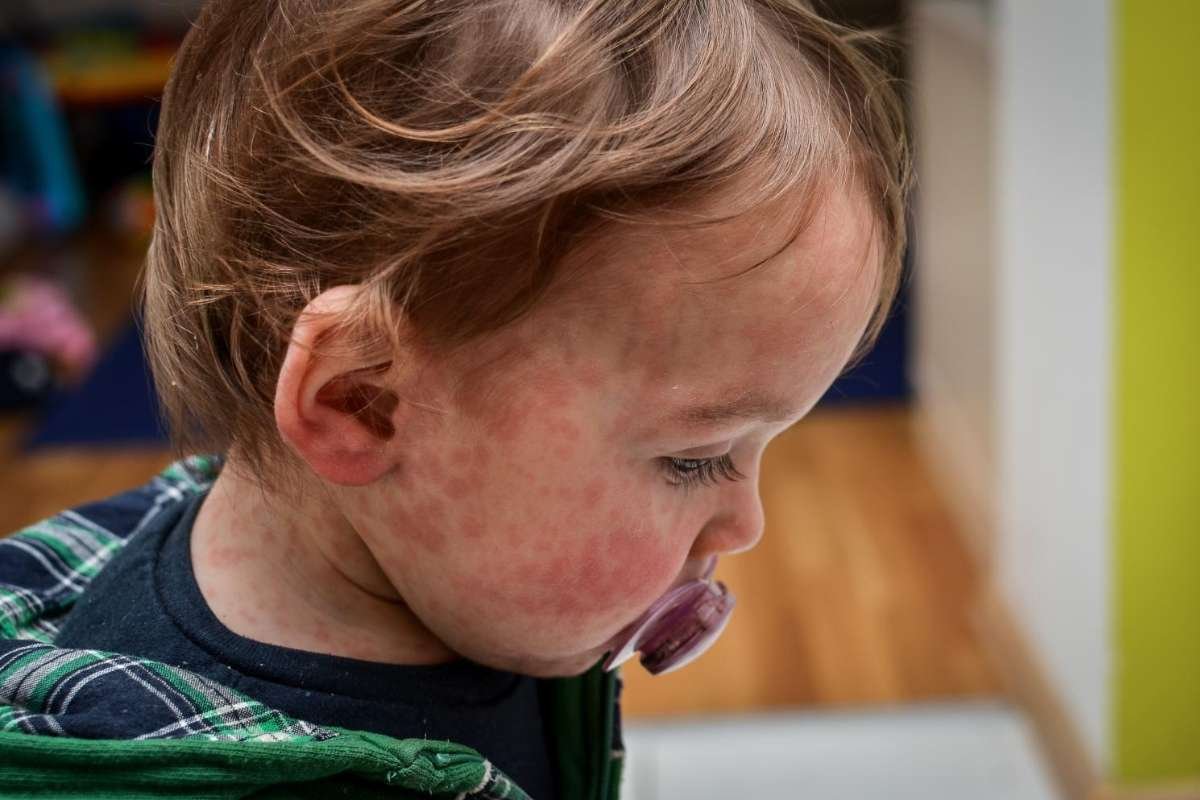 Pennsylvania Measles Outbreak Cases Top 1,000 As Outbreak Spreads | Healthcare 360 Magazine